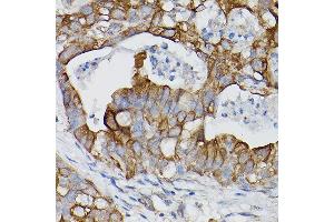 Immunohistochemistry of paraffin-embedded human lung cancer using IL18R1/IL-18 R alpha Rabbit pAb (ABIN3023690, ABIN3023691, ABIN3023692 and ABIN6219764) at dilution of 1:150 (40x lens). (IL18R1 Antikörper  (AA 19-320))