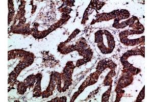 Immunohistochemical analysis of paraffin-embedded human-colon-cancer, antibody was diluted at 1:200. (GREM2 Antikörper  (AA 71-120))