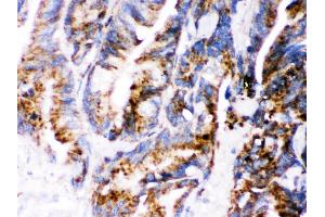 Cathepsin D was detected in paraffin-embedded sections of human Intestinal cancer tissues using rabbit anti- Cathepsin D Antigen Affinity purified polyclonal antibody at 1 μg/mL. (Cathepsin D Antikörper  (AA 201-412))