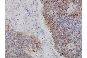 Immunoperoxidase of monoclonal antibody to IRAK2 on formalin-fixed paraffin-embedded human transitional cell carcinoma. (IRAK2 Antikörper  (AA 111-210))