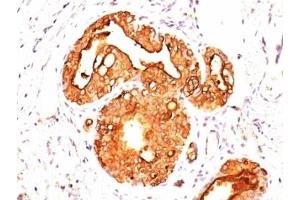 Formalin-fixed, paraffin-embedded human breast carcinoma stained with EMA antibody (MUC1/845). (MUC1 Antikörper)