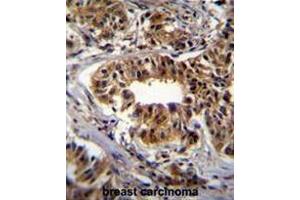 CAD Antibody (Center) immunohistochemistry analysis in formalin fixed and paraffin embedded human breast carcinoma followed by peroxidase conjugation of the secondary antibody and DAB staining. (CAD Antikörper  (Middle Region))