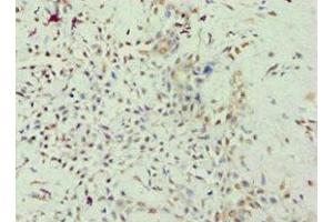 Immunohistochemistry of paraffin-embedded human breast cancer using ABIN7167947 at dilution of 1:100 (GRAF Antikörper  (AA 625-814))