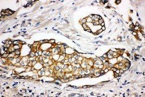 Anti-SPTLC1 antibody, IHC(P) IHC(P): Human Mammary Cancer Tissue (SPTLC1 Antikörper  (Middle Region))