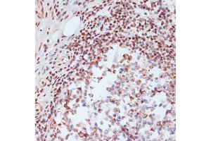Immunohistochemistry of paraffin-embedded human colon carcinoma using Phospho-CREB1-S133 Rabbit pAb (ABIN3023522, ABIN3023523, ABIN3023524 and ABIN6225375) at dilution of 1:200 (40x lens). (CREB1 Antikörper  (pSer133))