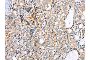 The image on the left is immunohistochemistry of paraffin-embedded Human thyroid cancer tissue using ABIN7191349(MAGEB2 Antibody) at dilution 1/40, on the right is treated with synthetic peptide. (MAGEB2 Antikörper)