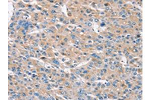 The image on the left is immunohistochemistry of paraffin-embedded Human liver cancer tissue using ABIN7192149(RASA3 Antibody) at dilution 1/30, on the right is treated with synthetic peptide. (RASA3 Antikörper)