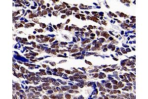 Immunohistochemistry analysis of paraffin-embedded human lung cancer using HDAC1 Polyclonal Antibody at dilution of 1:300. (HDAC1 Antikörper)