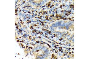 Immunohistochemistry of paraffin-embedded human colon carcinoma using T Rabbit mAb (ABIN7270916) at dilution of 1:100 (40x lens). (TACC3 Antikörper)