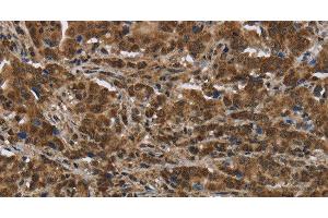 Immunohistochemistry of paraffin-embedded Human liver cancer tissue using PIP Polyclonal Antibody at dilution 1:50 (PIP Antikörper)