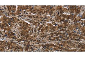 Immunohistochemistry of paraffin-embedded Human liver cancer tissue using PIP Polyclonal Antibody at dilution 1:50 (PIP Antikörper)