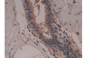Detection of GARS in Human Breast cancer Tissue using Polyclonal Antibody to Glycyl tRNA Synthetase (GARS) (GARS Antikörper  (AA 567-735))