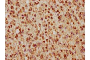 IHC image of nhibHU diluted at 1:5 and staining in paraffin-embedded human glioma cancer performed on a Leica BondTM system. (Histone H2B Antikörper  (AA 53-64))