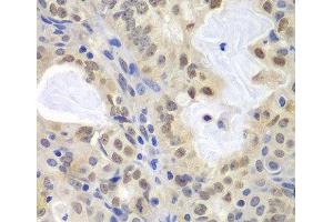 Immunohistochemistry of paraffin-embedded Human oophoroma using MCM3 Polyclonal Antibody at dilution of 1:100 (40x lens). (MCM3 Antikörper)