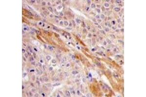 IHC analysis of FFPE human hepatocarcinoma tissue stained with PGK1 antibody (PGK1 Antikörper  (AA 305-334))