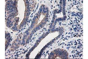 Immunohistochemical staining of paraffin-embedded Adenocarcinoma of Human endometrium tissue using anti-CCM2 mouse monoclonal antibody. (CCM2 Antikörper)