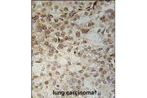 C14orf179 Antibody immunohistochemistry analysis in formalin fixed and paraffin embedded human lung carcinoma followed by peroxidase conjugation of the secondary antibody and DAB staining. (IFT43 Antikörper  (AA 145-171))