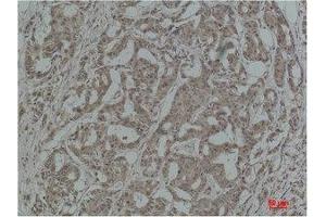 Immunohistochemistry (IHC) analysis of paraffin-embedded Human Breast Carcinoma using Stat3 Polyclonal Antibody. (STAT3 Antikörper)