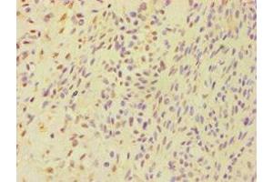 Immunohistochemistry of paraffin-embedded human breast cancer using ABIN7145262 at dilution of 1:100 (BSND Antikörper  (AA 54-320))