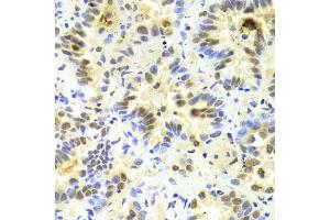 Immunohistochemistry of paraffin-embedded human lung cancer using SRSF1 Antibody (ABIN5970815) at dilution of 1/100 (40x lens). (SRSF1 Antikörper)
