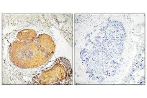 Immunohistochemical analysis of paraffin-embedded human breast carcinoma tissue, using FADD (Phospho-Ser190) antibody (left)or the same antibody preincubated with blocking peptide (right). (FADD Antikörper  (pSer191))
