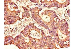 Immunohistochemistry of paraffin-embedded human colon cancer using ABIN7169453 at dilution of 1:100 (SH2D1B Antikörper  (AA 1-77))
