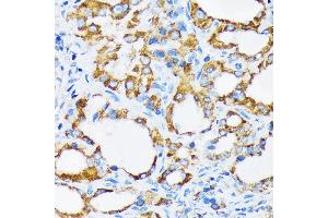 Immunohistochemistry of paraffin-embedded human thyroid cancer using PIST/GOPC Rabbit mAb (ABIN1678809, ABIN1678808, ABIN7101325 and ABIN7101326) at dilution of 1:100 (40x lens). (GOPC Antikörper)