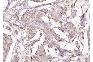 ABIN6267696 at 1/100 staining human Breast cancer tissue sections by IHC-P. (DARPP32 Antikörper  (pThr75))