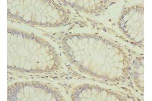 Immunohistochemistry of paraffin-embedded human colon cancer using ABIN7146772 at dilution of 1:100 (CPD Antikörper  (AA 860-1100))