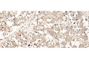Immunohistochemistry of paraffin-embedded Human lung cancer tissue using RRP1 Polyclonal Antibody at dilution of 1:45(x200)