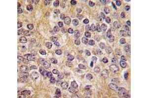 IHC analysis of FFPE human prostate carcinoma tissue stained with UPA antibody (PLAU Antikörper  (AA 396-426))