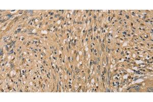 Immunohistochemistry of paraffin-embedded Human cervical cancer tissue using SETD2 Polyclonal Antibody at dilution 1:40 (SETD2 Antikörper)