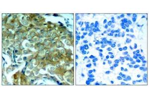 Immunohistochemical analysis of paraffin-embedded human breast carcinoma tissue, using (EGFR Antikörper  (pTyr1172))