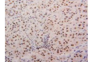 IHC-P analysis of Human Liver Cancer Tissue, with DAB staining. (HNRNPA2B1 Antikörper  (AA 21-103))