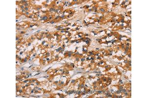Immunohistochemistry of Human gastric cancer using CD80 Polyclonal Antibody at dilution of 1:50 (CD80 Antikörper)