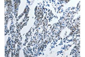 The image on the left is immunohistochemistry of paraffin-embedded Human gastric cancer tissue using ABIN7191895(PIWIL3 Antibody) at dilution 1/20, on the right is treated with synthetic peptide. (PIWIL3 Antikörper)