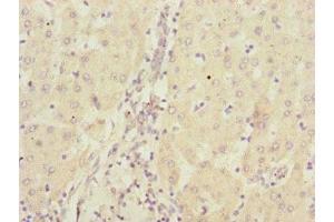 Immunohistochemistry of paraffin-embedded human liver cancer using ABIN7146746 at dilution of 1:100 (CBR4 Antikörper  (AA 1-237))