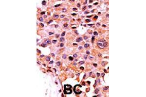 Formalin-fixed and paraffin-embedded human cancer tissue reacted with PPP3CA polyclonal antibody  , which was peroxidase-conjugated to the secondary antibody, followed by AEC staining. (PPP3CA Antikörper  (N-Term))