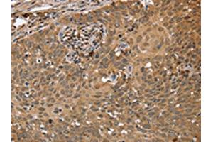 The image on the left is immunohistochemistry of paraffin-embedded Human cervical cancer tissue using ABIN7191664(NMT1 Antibody) at dilution 1/45, on the right is treated with synthetic peptide. (NMT1 Antikörper)