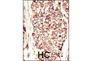 Formalin-fixed and paraffin-embedded human cancer tissue reacted with the primary antibody, which was peroxidase-conjugated to the secondary antibody, followed by AEC staining. (ErbB2/Her2 Antikörper  (N-Term))