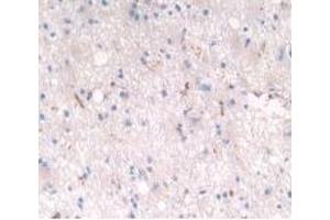 Detection of LRP4 in Human Glioma Tissue using Polyclonal Antibody to Low Density Lipoprotein Receptor Related Protein 4 (LRP4) (LRP4 Antikörper  (AA 1610-1885))