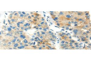 Immunohistochemistry of paraffin-embedded Human liver cancer using PDPN Polyclonal Antibody at dilution of 1/20 (Podoplanin Antikörper)