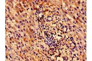 Immunohistochemistry of paraffin-embedded human liver cancer using ABIN7176118 at dilution of 1:100 (ZNF155 Antikörper  (AA 1-538))
