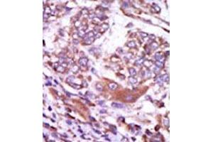 Formalin-fixed and paraffin-embedded human cancer tissue (hepatocarcinoma) reacted with the primary antibody, which was peroxidase-conjugated to the secondary antibody, followed by AEC staining. (CAMK2D Antikörper  (C-Term))