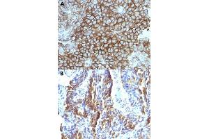 Immunohistochemical staining (Formalin-fixed paraffin-embedded sections) of (A) human melanoma and (B) human tongue with Melanoma monoclonal antibody, clone KBA. (Melanoma Antikörper)