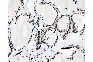Immunohistochemical staining of paraffin-embedded Adenocarcinoma of breast tissue using anti-CAMK1D mouse monoclonal antibody. (CAMK1D Antikörper)