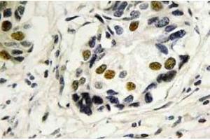 Immunohistochemistry (IHC) analyzes of p53 antibody in paraffin-embedded human breast carcinoma tissue. (p53 Antikörper)