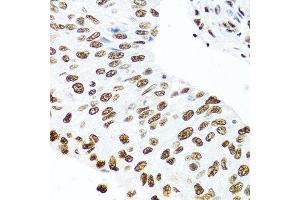 Immunohistochemistry of paraffin-embedded human prostate cancer using SSB antibody at dilution of 1:100 (40x lens). (SSB Antikörper)