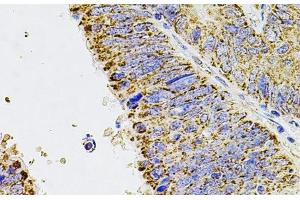 Immunohistochemistry of paraffin-embedded Human colon carcinoma using ALDH1A1 Polyclonal Antibody at dilution of 1:100 (40x lens). (ALDH1A1 Antikörper)