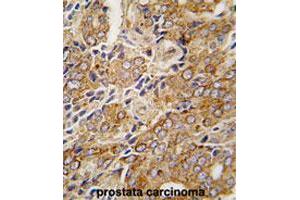 Formalin-fixed and paraffin-embedded human prostate carcinomareacted with TRPM8 polyclonal antibody , which was peroxidase-conjugated to the secondary antibody, followed by AEC staining. (TRPM8 Antikörper  (AA 933-963))